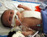 Explicación de negligencia médica en anestesia Nº 5: nene cuadripléjico por sobredosis de anestesia