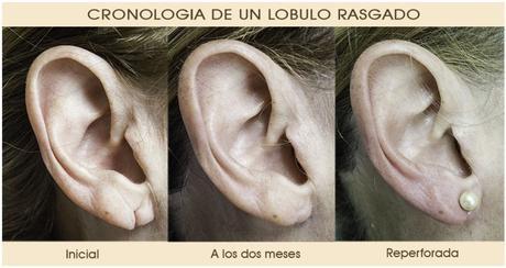 RECONSTRUCCIÓN DE LÓBULOS RASGADOS