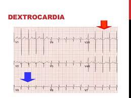 Dextrocardia: síndrome del corazón al revés.