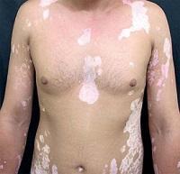 vitiligo en el cuerpo