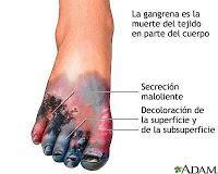 Explicación de caso de negligencia en anestesia Nº 10: Fue a dar a luz y le amputaron las manos y las piernas Explicación de caso de negligencia en anestesia Nº 10: Fue a dar a luz y le amputaron las manos y las piernas