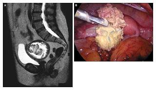 Explicación de caso de negligencia en anestesia Nº 10: Fue a dar a luz y le amputaron las manos y las piernas Explicación de caso de negligencia en anestesia Nº 10: Fue a dar a luz y le amputaron las manos y las piernas