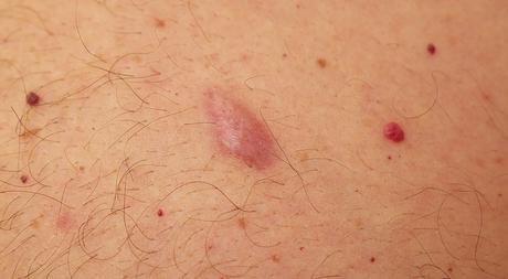 Bultos comunes no cancerosos bajo la piel