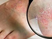 ¿Qué causa dermatitis pierna pies inferiores?