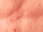 Esteatocistoma multiplex tratamientos