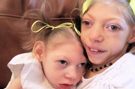 Aprueban Nuevo Farmaco para Tratar la Enfermedad de Batten