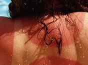 Remedios caseros alivian quemaduras