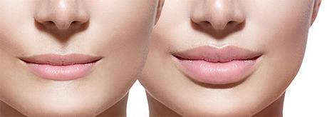 Beneficios del ácido hialurónico