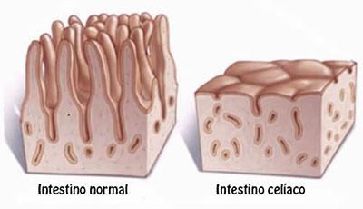 Causas de la celiaquía