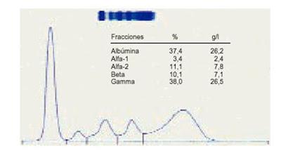 Interpretación del proteinograma