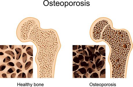 Qué debe hacer para detectar si padece de Osteoporosis #Medicina #Salud