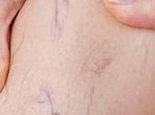 Varices