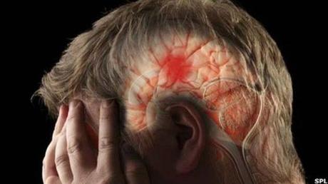 Estos son los principales síntomas de un derrame cerebral #Medioc #Medicina #Salud