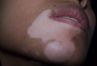 vitiligo en la cara