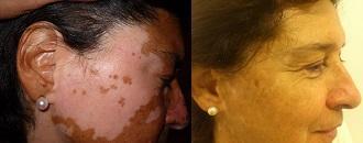 vitiligo antes y despues