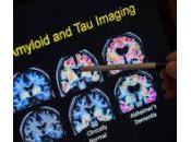 Prevalencia edad-específica sexo-específica β-amiloidosis cerebral, taupatía neurodegeneración personas cognitivamente indemnes 50-95 años: estudio transversal.