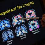 Prevalencia edad-específica y sexo-específica de β-amiloidosis cerebral, taupatía y neurodegeneración en personas cognitivamente indemnes de 50-95 años: estudio transversal.