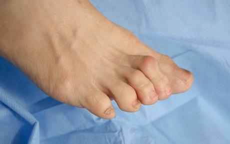 Cirugía del dedo del pie del martillo