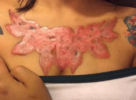 El #infierno que vivió una joven tailandesa después de intentar quitarse un #tatuaje #Tatoo (FOTOS)