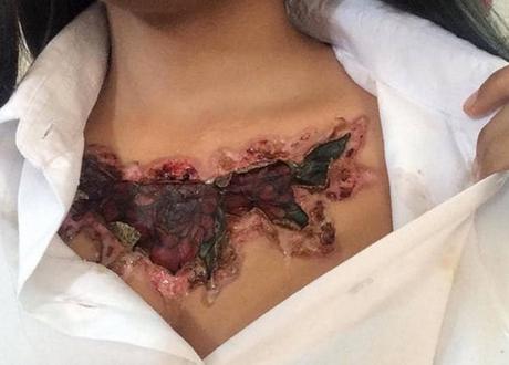 El #infierno que vivió una joven tailandesa después de intentar quitarse un #tatuaje #Tatoo (FOTOS)