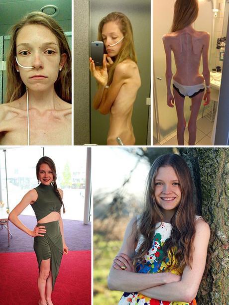 Impresionante: 20 personas que lograron superar la anorexia