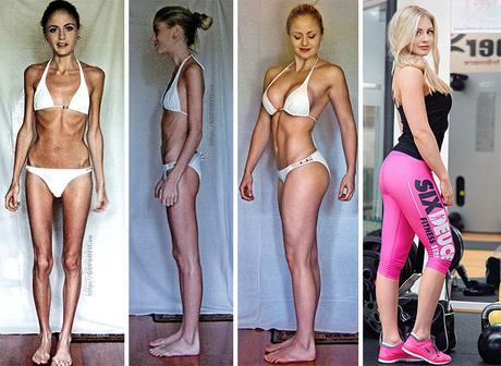 Impresionante: 20 personas que lograron superar la anorexia