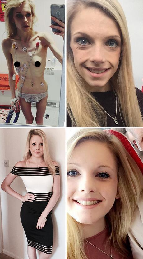 Impresionante: 20 personas que lograron superar la anorexia