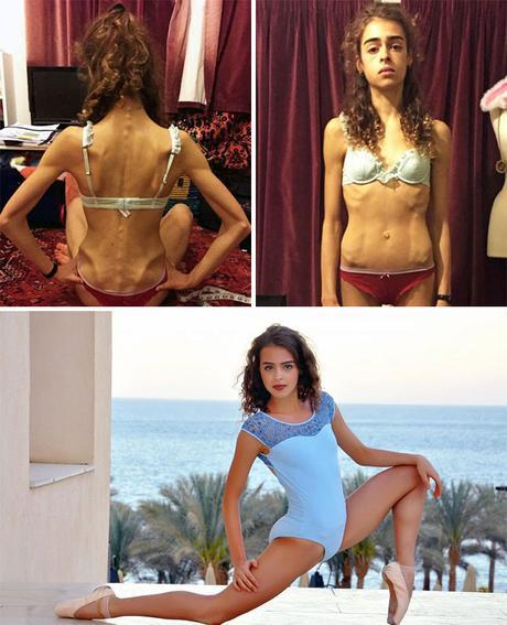 Impresionante: 20 personas que lograron superar la anorexia