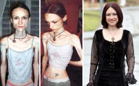 Impresionante: 20 personas que lograron superar la anorexia