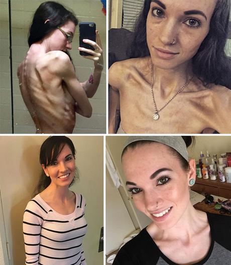 Impresionante: 20 personas que lograron superar la anorexia