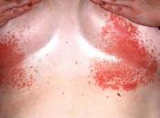 Dermatitis bajo pecho