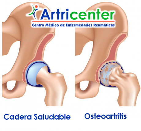 OSTEOARTRITIS DE CADERA