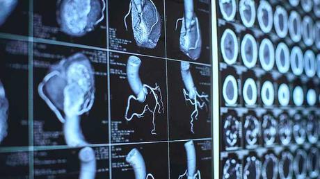 Tratamiento de fibrilación atrial: medicamentos, procedimientos y cambios en el estilo de vida Tratamiento de fibrilación atrial: medicamentos, procedimientos y cambios en el estilo de vida