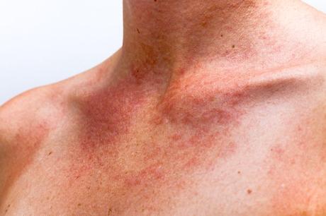 Envenenamiento por el sol o fotodermatitis