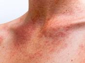 Envenenamiento fotodermatitis