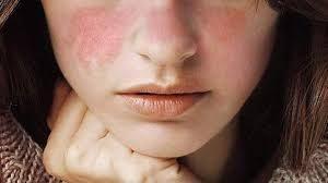 El significado de soñar con lupus. El significado de soñar con lupus.