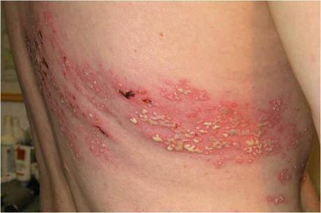 El virus de la varicela-zoster atrae a los leucocitos