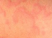 Alergia Sol: Fotodermatosis #ModoVerano