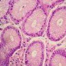 Enfermedades relacionadas Endometriosis