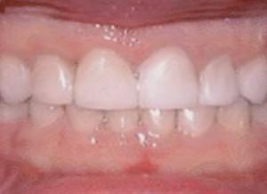 bruxismo Qué es el bruxismo y cómo se soluciona