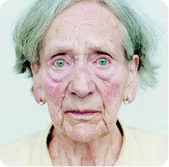 Alto colesterol e hipertensión ligados a problemas de memoria