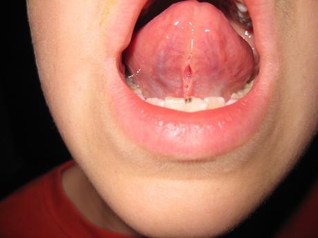 Frenillo desgarrado bajo la lengua: ¿ahora qué?