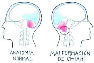 Comparación de cerebro normal con Chiari