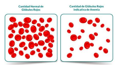 Anemia: hemoblogina baja
