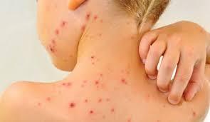 El significado de soñar con la sarna. El significado de soñar con la sarna.