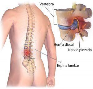 Hernia de disco tratamiento quiropráctico