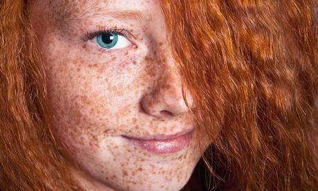 Resultado de imagen para efelides