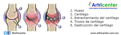 Evolución de la osteoartritis