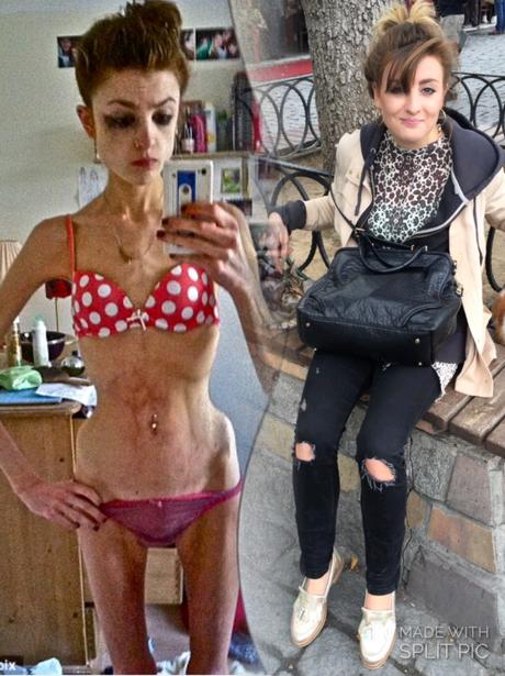 Mira estas 5 hermosas mujeres que superaron la anorexia