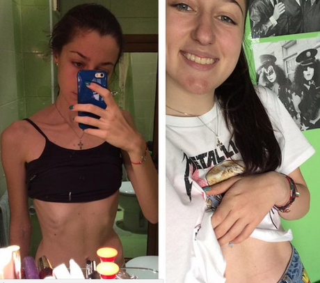 Mira estas 5 hermosas mujeres que superaron la anorexia